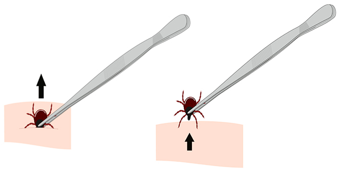 Extraindo o carrapato da pele