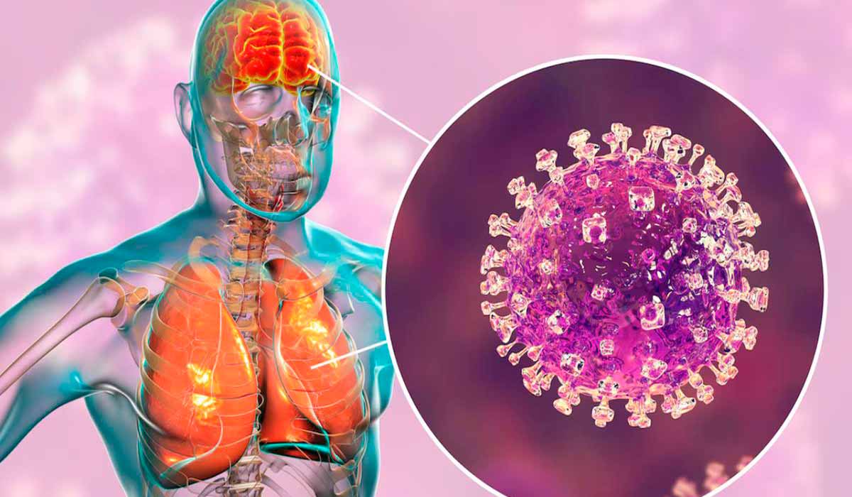 Infecção pelo vírus Nipah pode causar insuficiência respiratória e encefalite Infecção pelo vírus Nipah pode causar insuficiência respiratória e encefalite